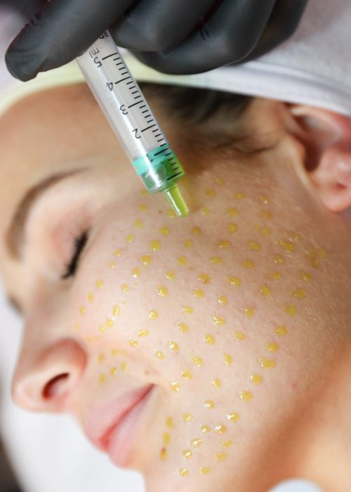 BioRePeel X Facial