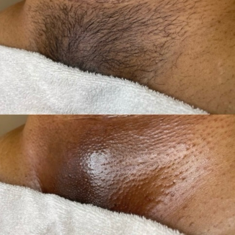 Brazilian Wax at SKYNSENSE in Pikesville, MD
