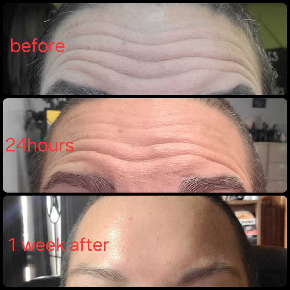 Upper Face Lift