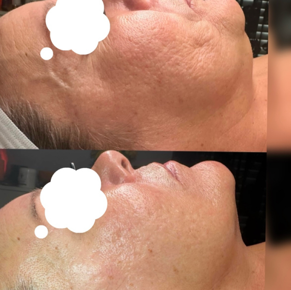 SWiCH Dermal Rejuvenation Treatmen