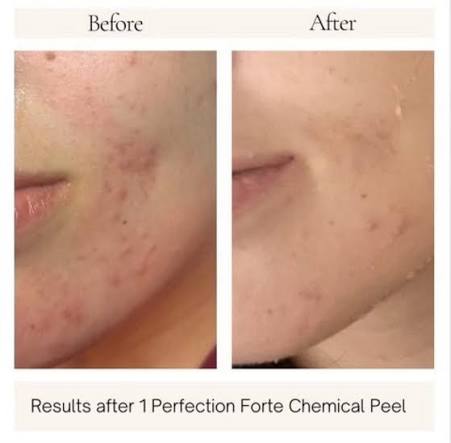IPEEL | PERFECTION LIFT