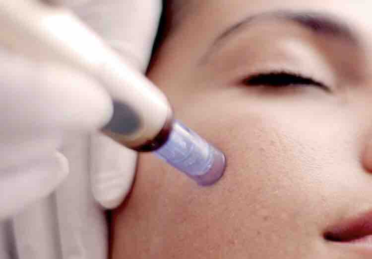 Microneedling with Procell MD