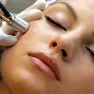 Microdermabraision Facial