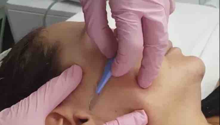 Dermaplaning Facial Treatment