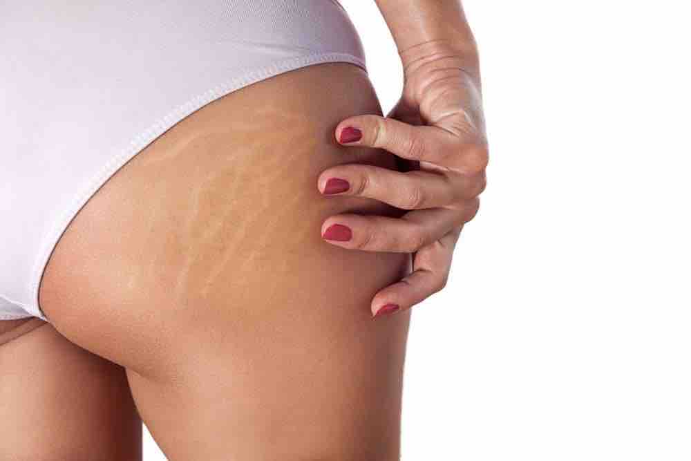 Microchaneling Stretch Marks Glute