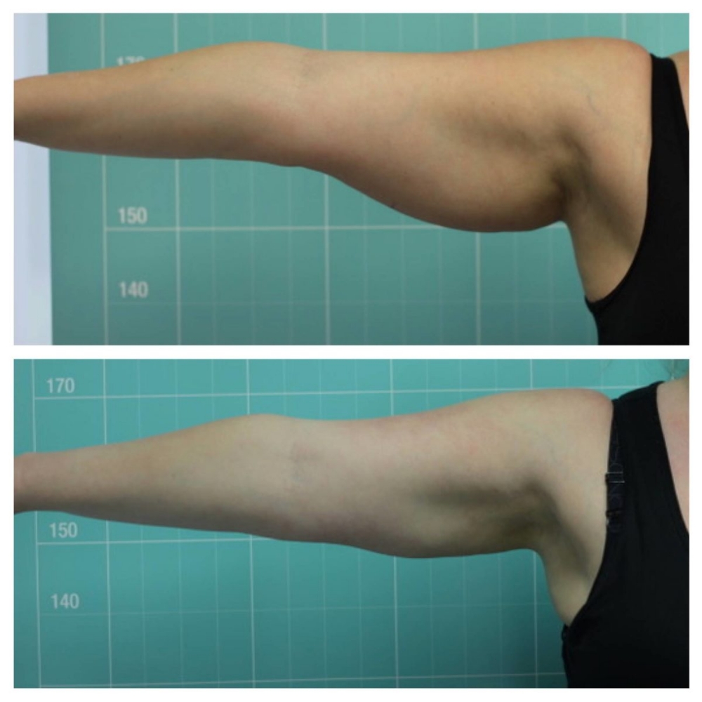 (6  ) LIPO CAVITATION ARMS