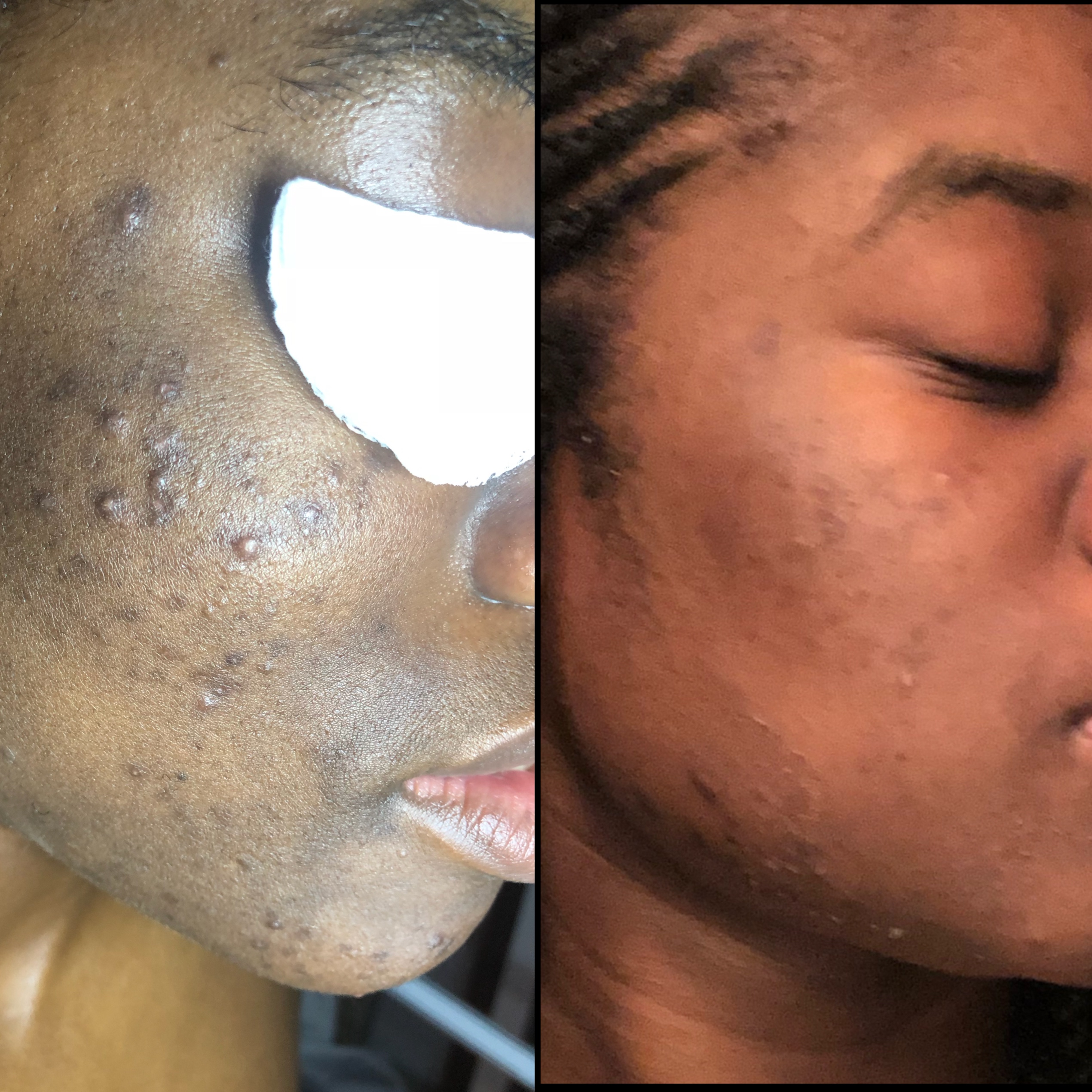 Chemical Peel at Trale Beauty in Lewisville, TX