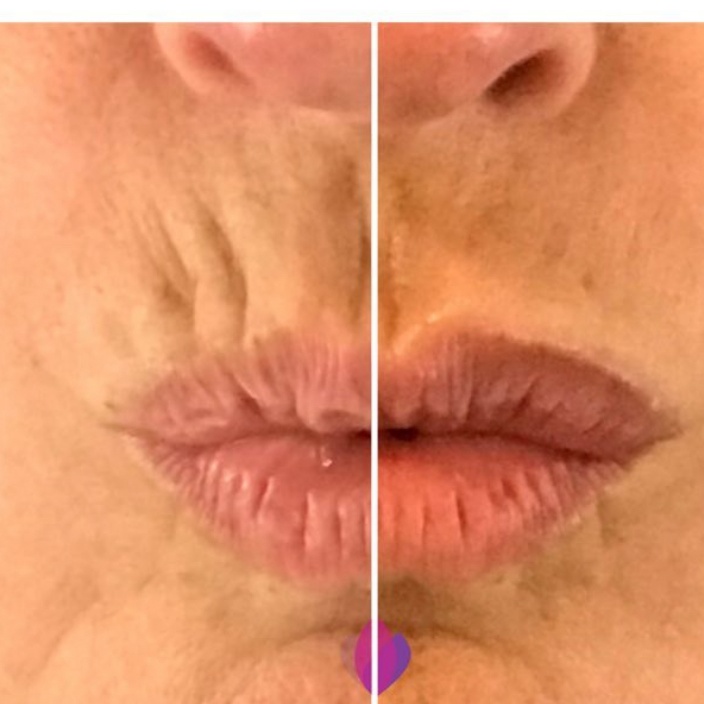Perioral Filler at BLUSH Aesthetics LLC in Laredo, TX