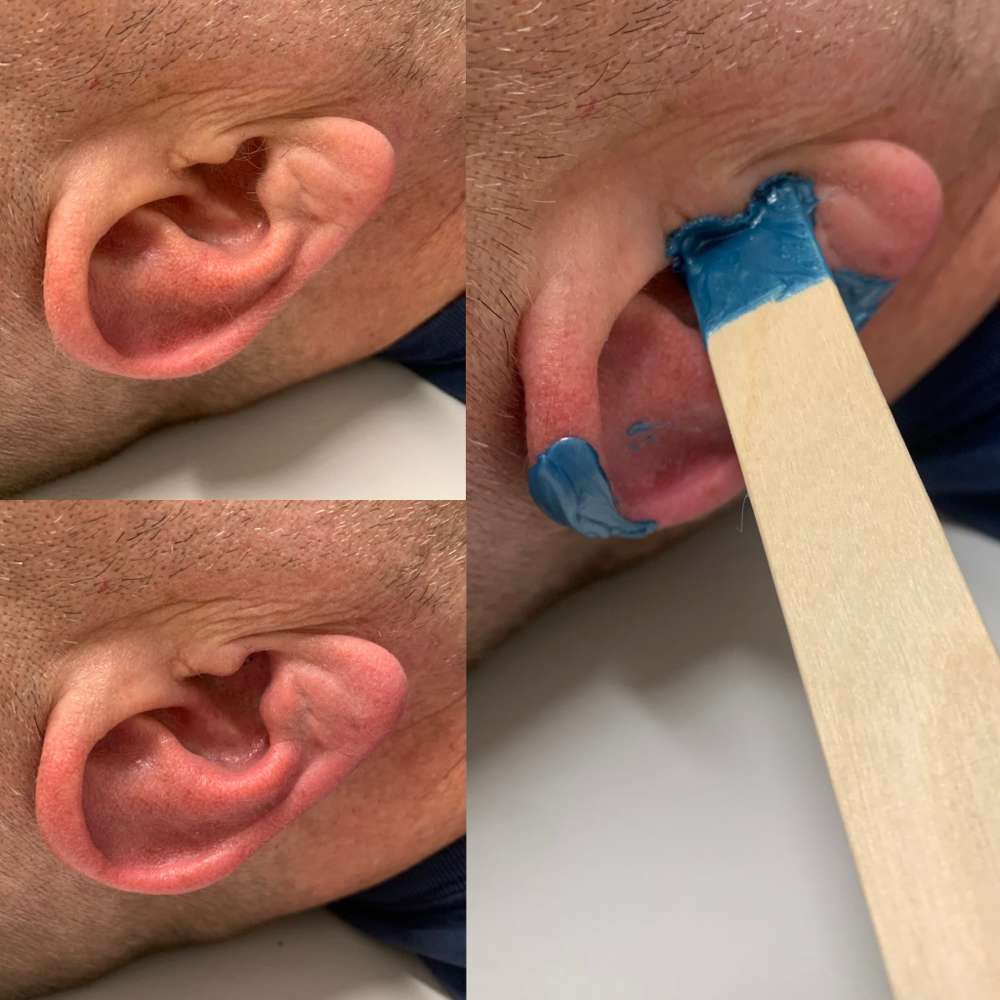 Ear Waxing