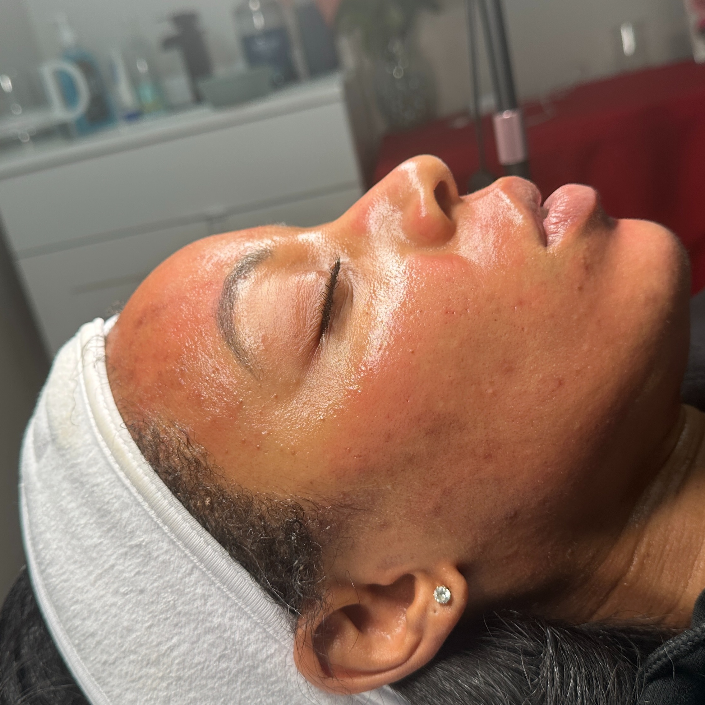 Microneedling Treatment at Skin Rehab in Charlotte, NC