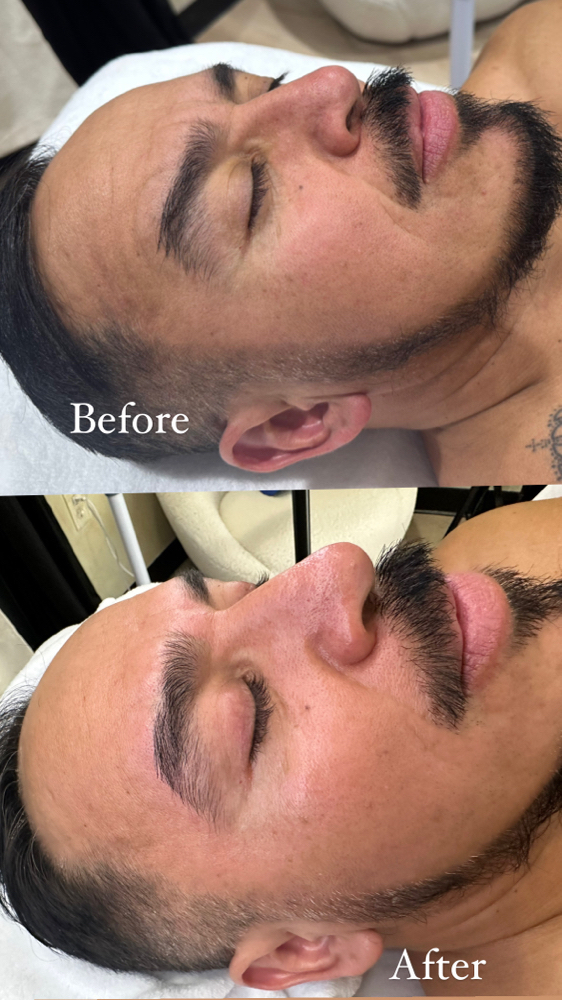 Baby Botox Facial