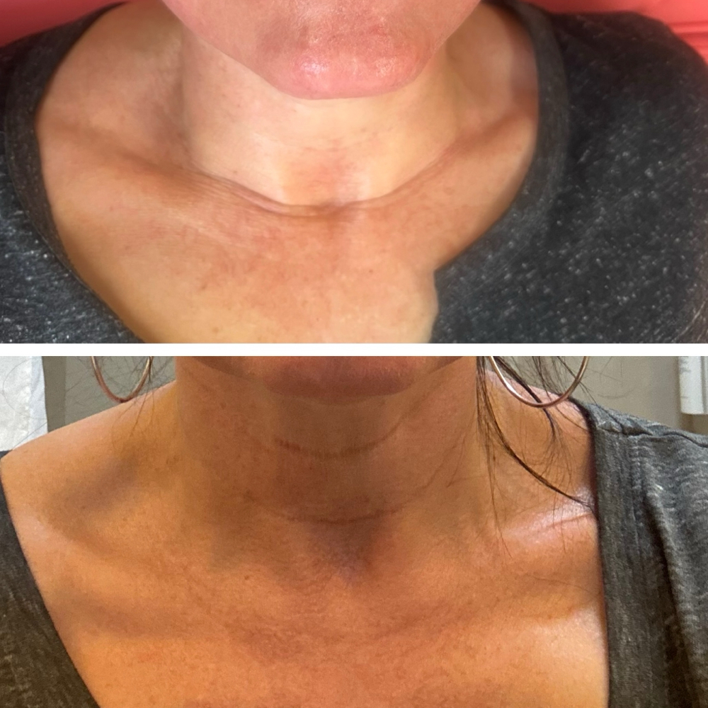 Tightening Affect: Neck