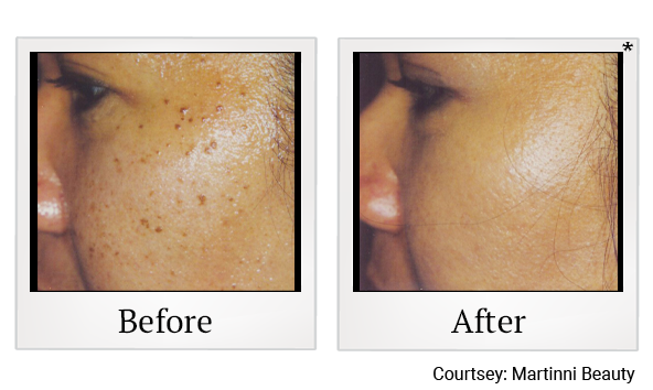 Skin Irregularity Removal Consult