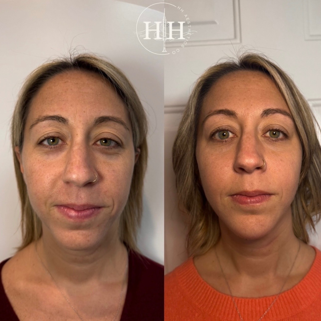 Facial Sculpt at HH Aesthetics Co in Milford, DE