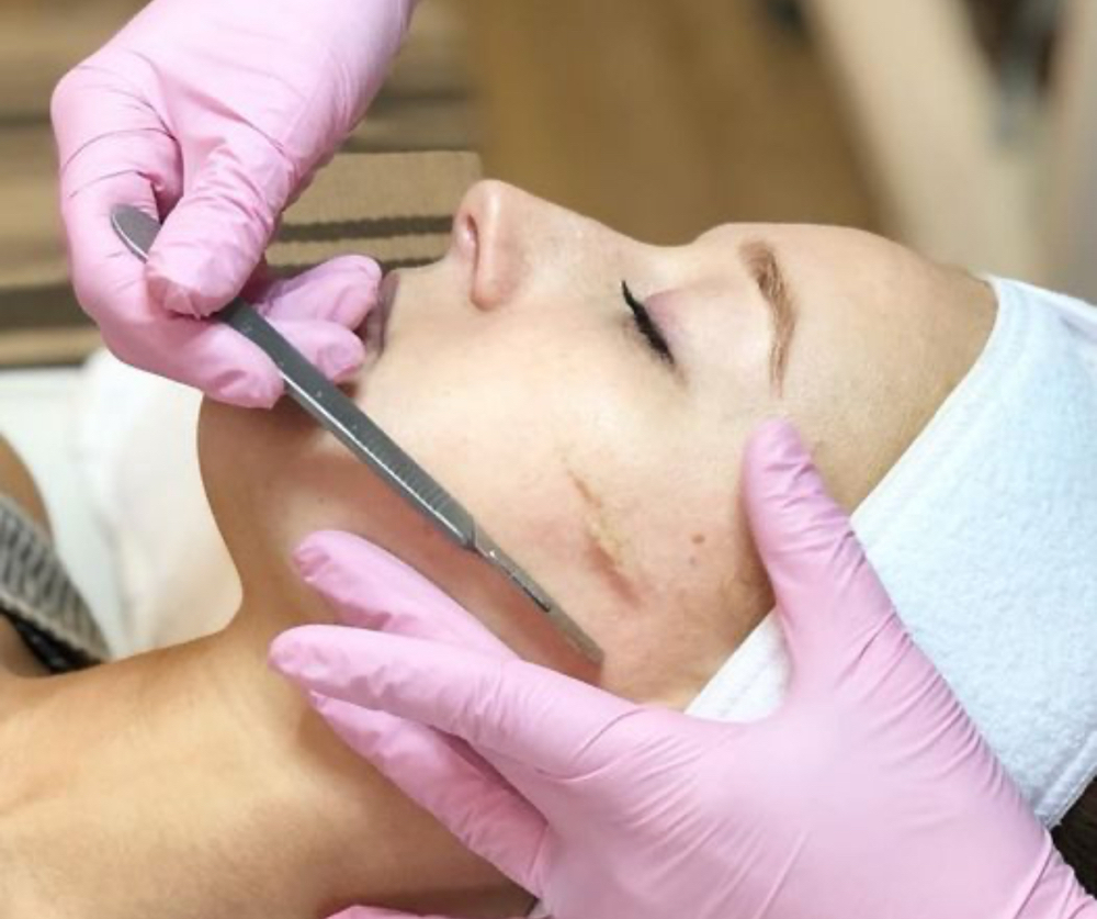 Dermaplaning