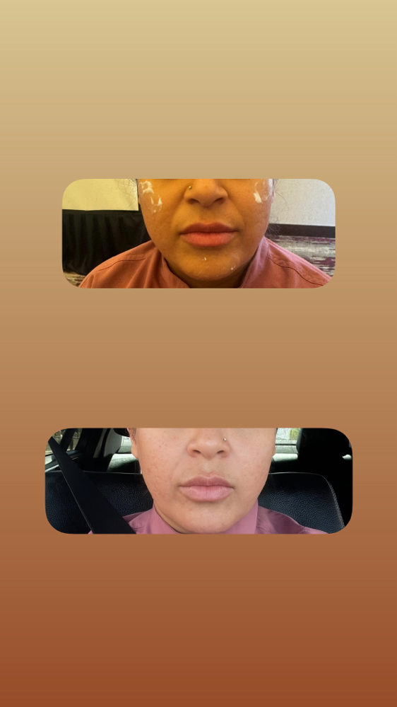 Cheek Filler