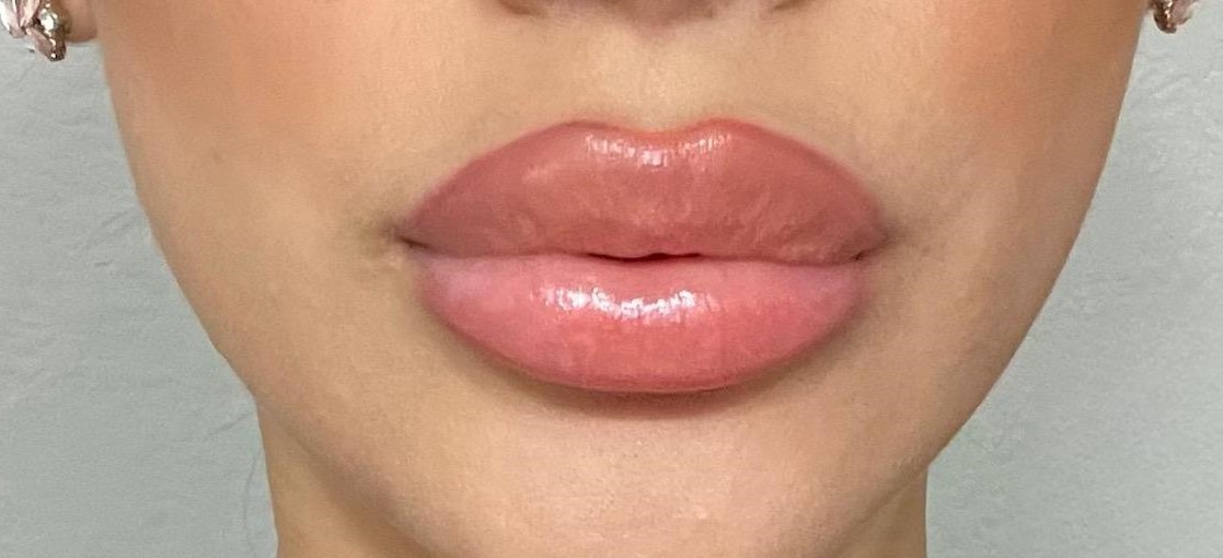 Needleless Lip Enhancement