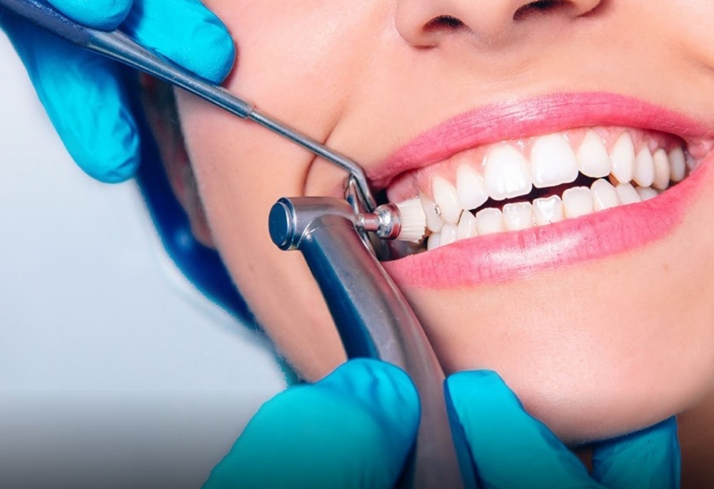 Full Mouth Cleaning