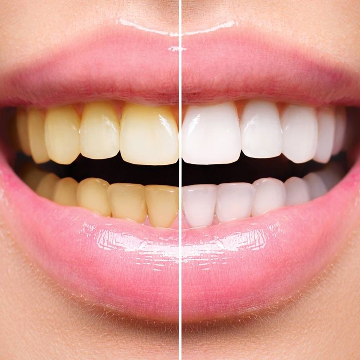 80 Minute (TEETH WHITENING)