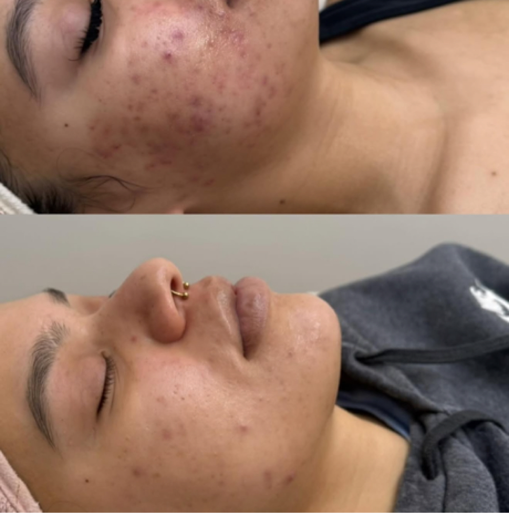 Acne facial at SknvibesbyDani in Bridgeport, CT