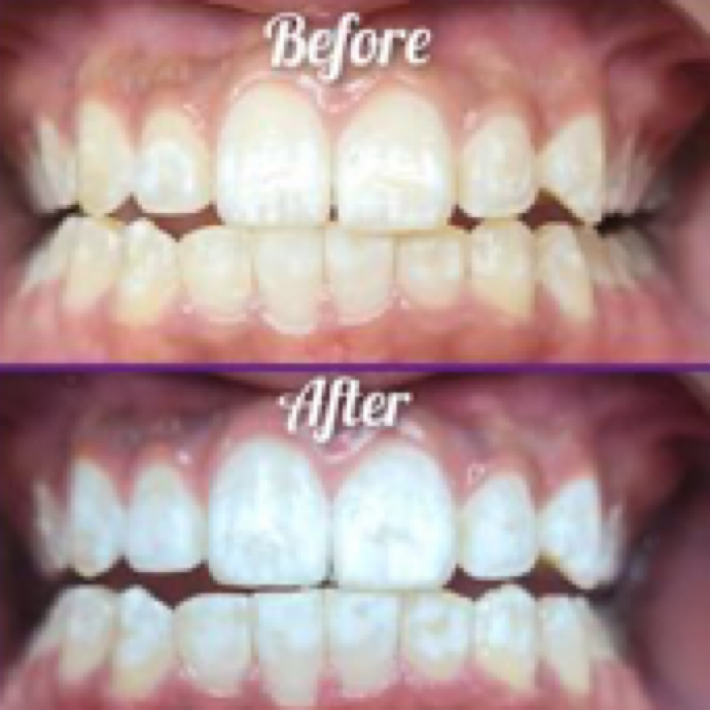40 Min Teeth Whiting Session at iGlow Skin Solutions LLC in Eatontown, NJ