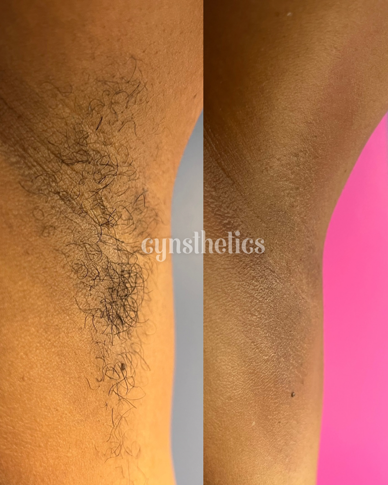 underarms at Cynsthetics Skincare in Brooklyn, NY