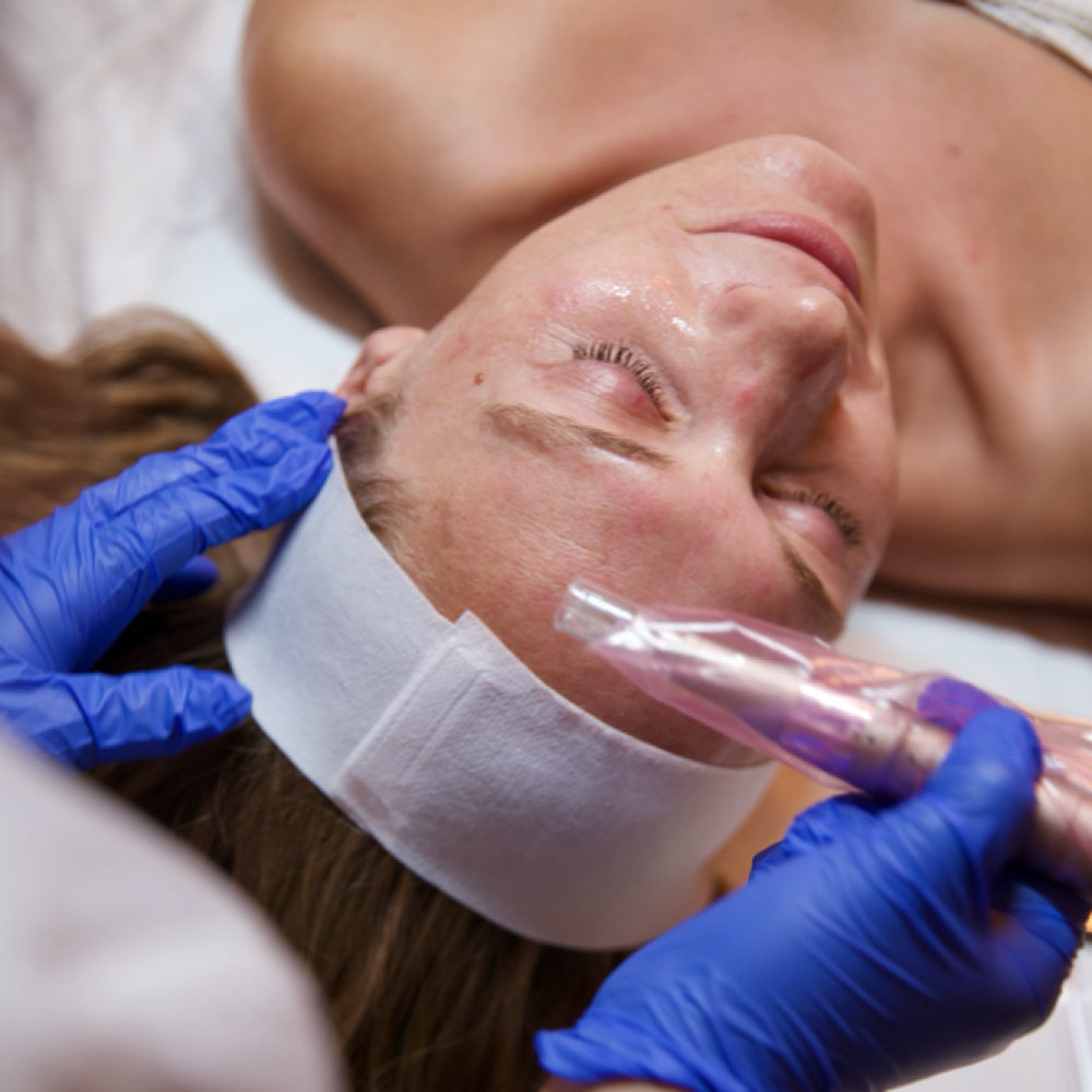 Microneedling at The Dermal Formula in San Mateo, CA