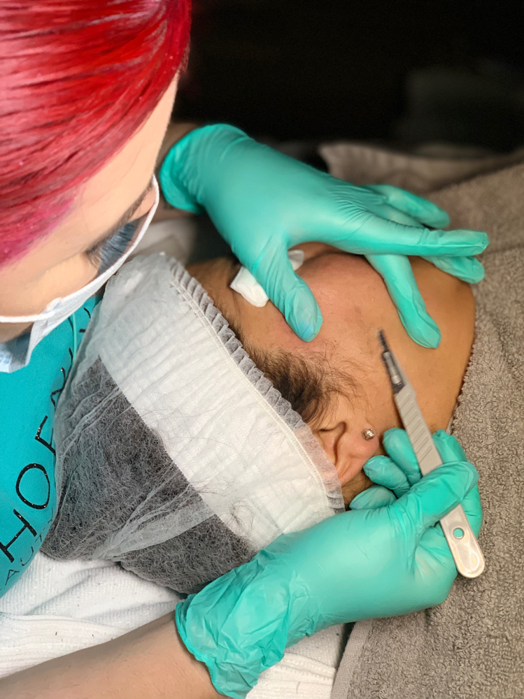 Dermal Planing Facial