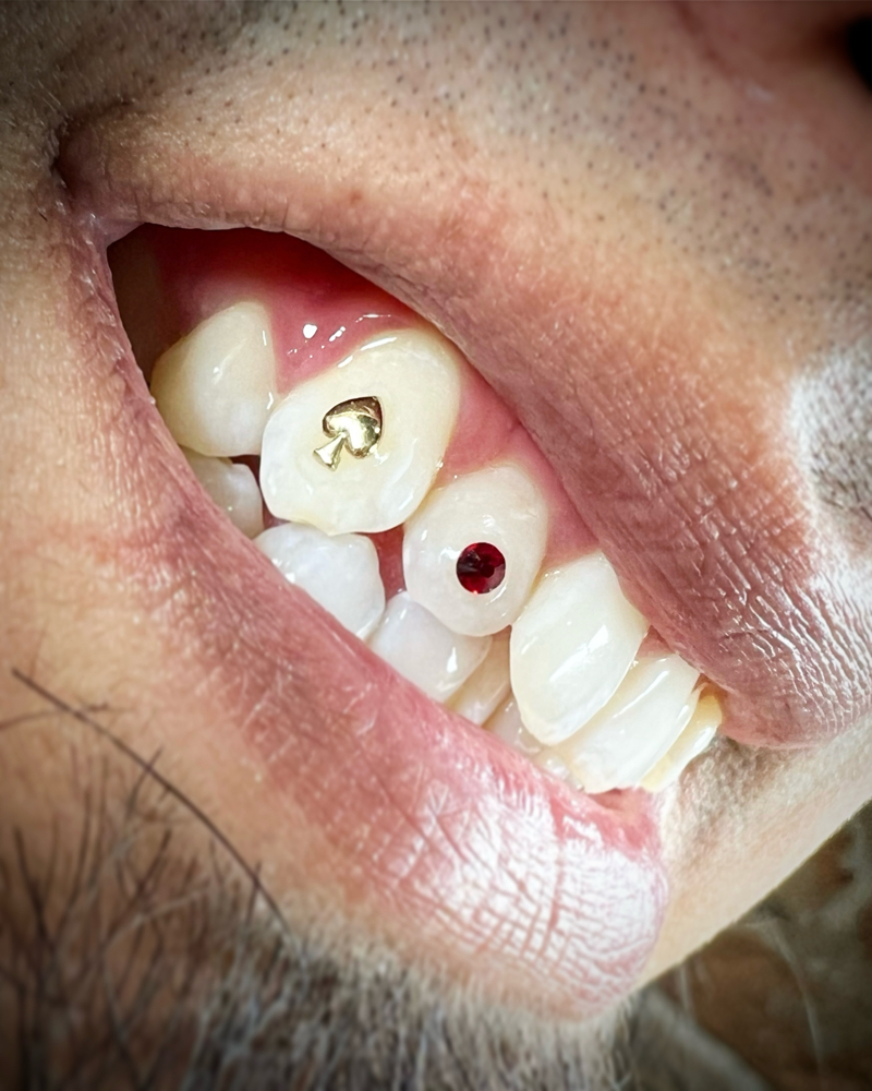 Tooth Gem Replacement