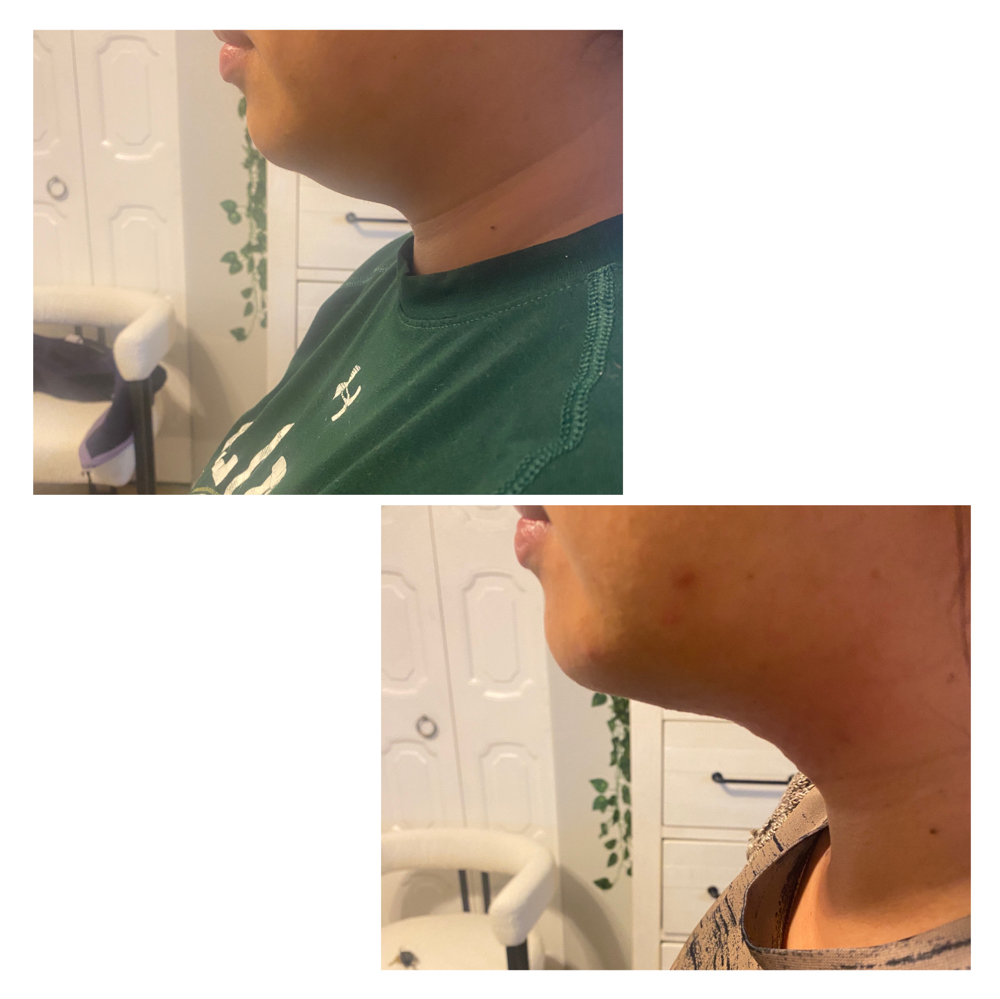 Double Chin Fat Dissolvers 1 Sessio