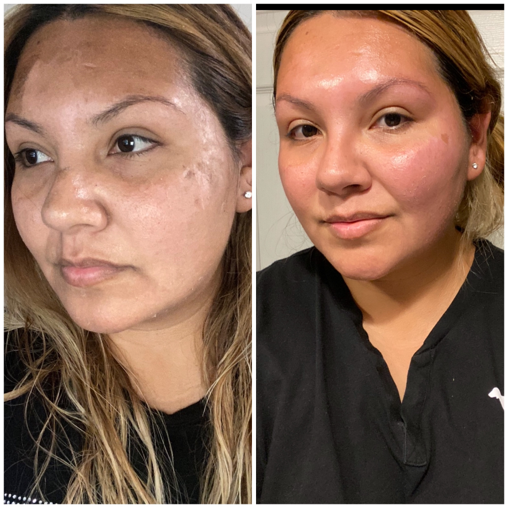 TCA Peel For Acne/Hyperpigmentation at Advanced Skincare & Laser By Jess in Naples, FL