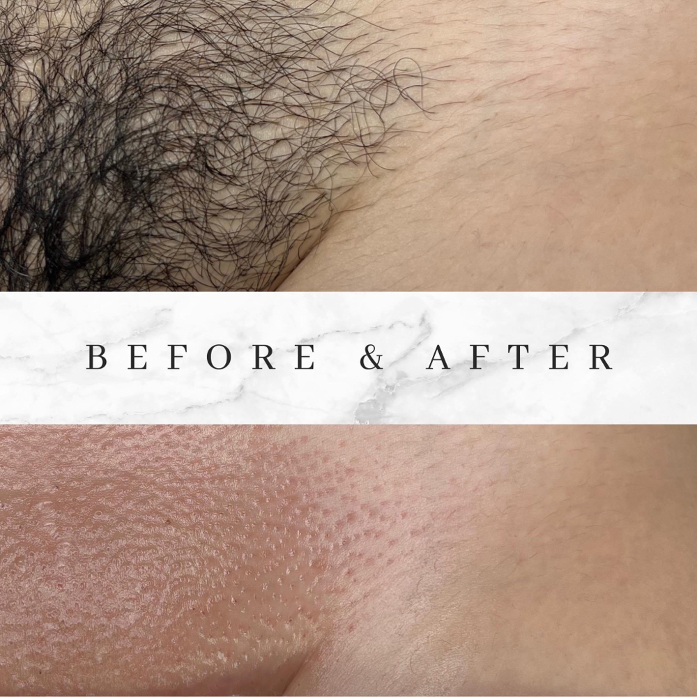 Depilación Wax (brazilian