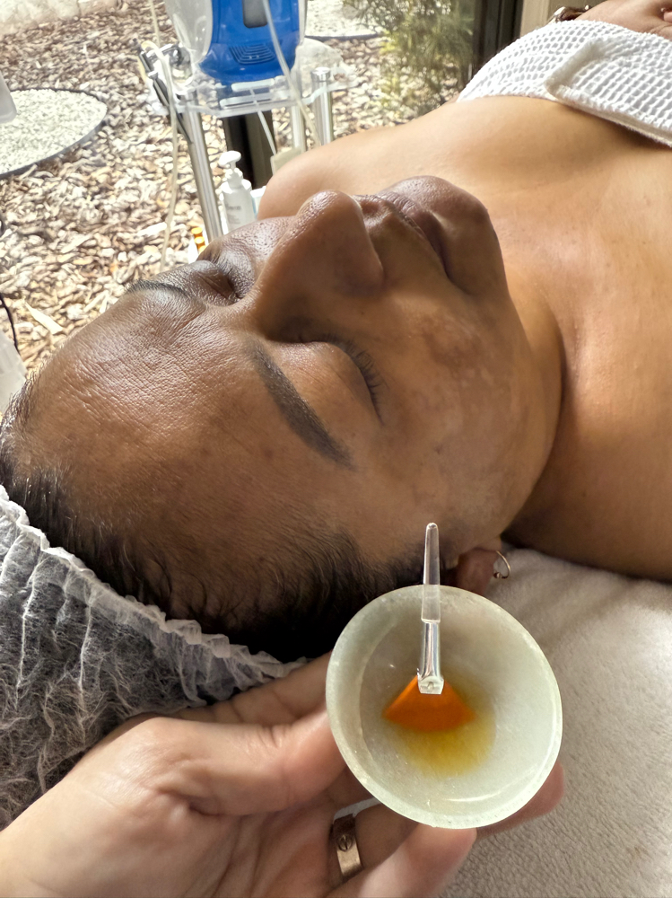 Chemical Peel