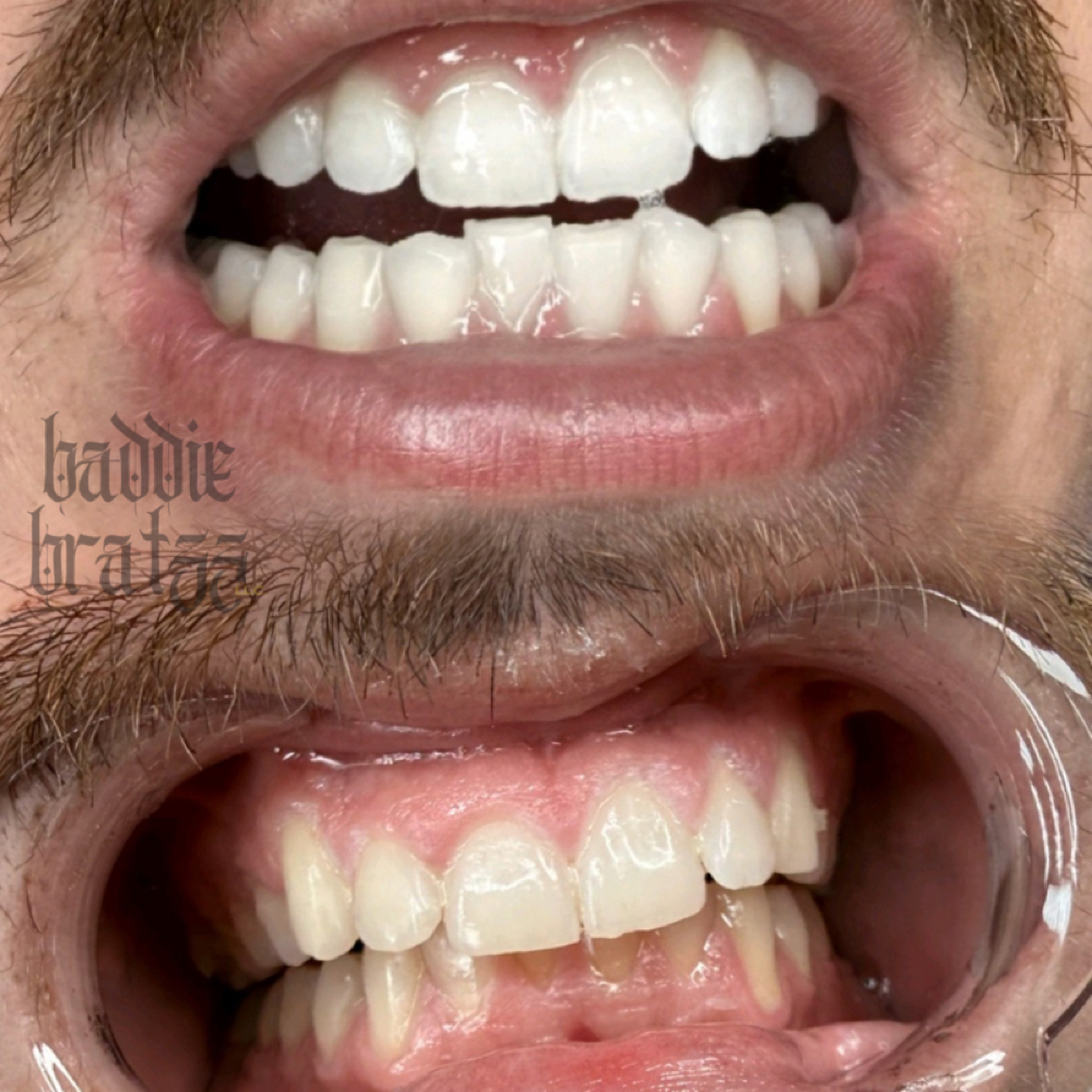 Teeth Whitening- 60 Minutes