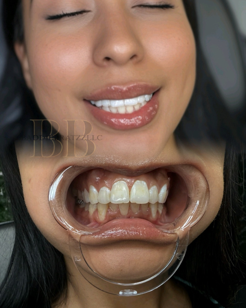 Teeth Whitening- 60 Minutes