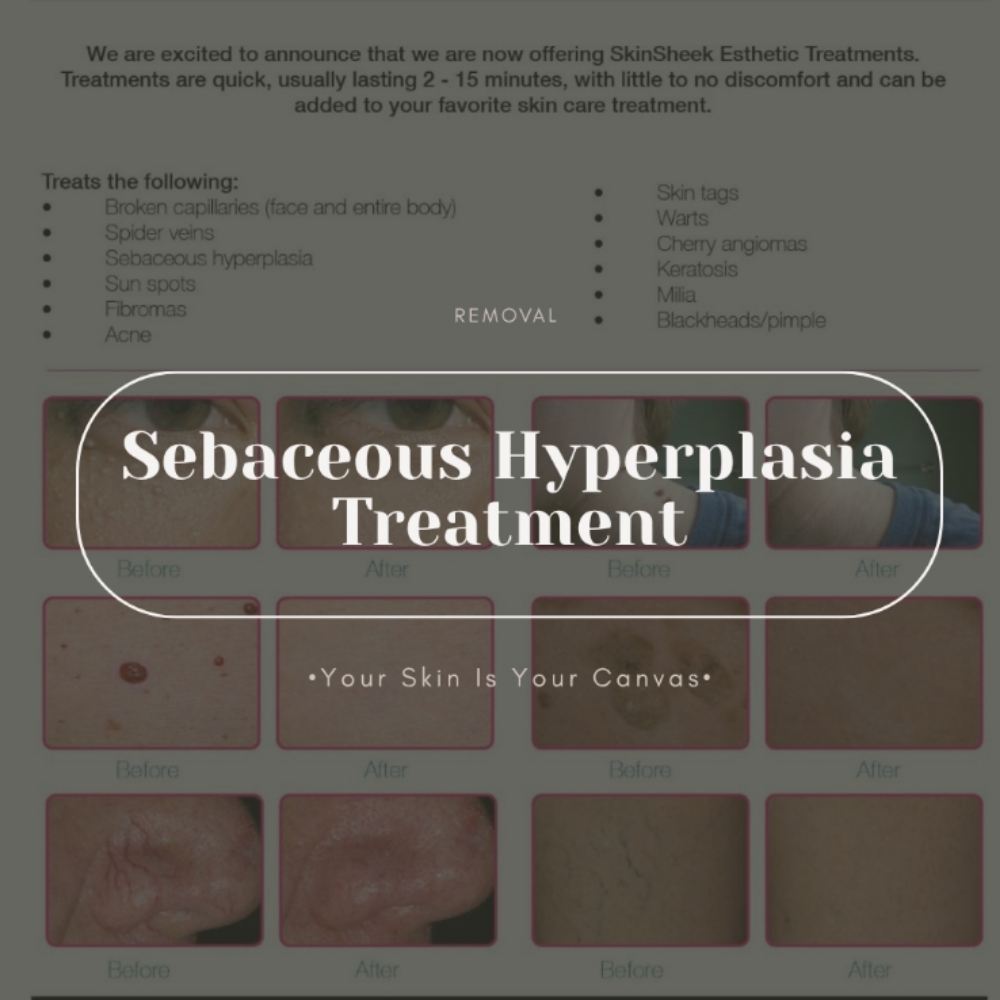 Sebaceous Hyperplasia Treatment at Face Palette Aesthetics in Franklin, WI