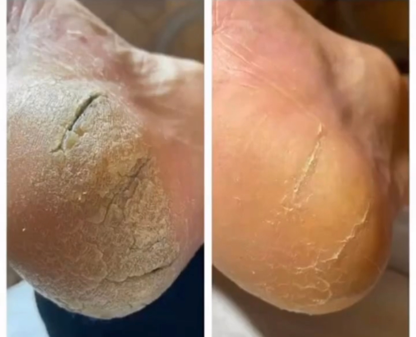 Callus Reduction Treatmemt