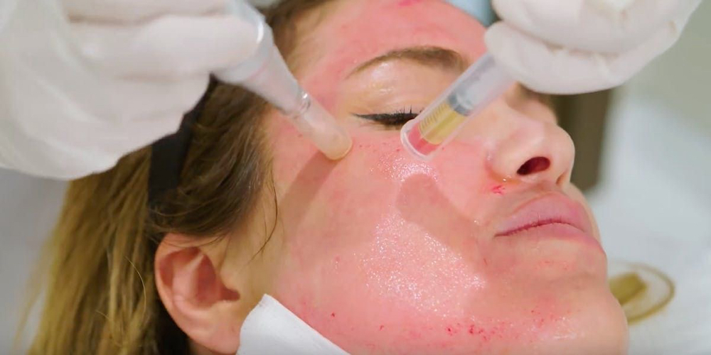 Vampire Facial (PRP Microneedling)