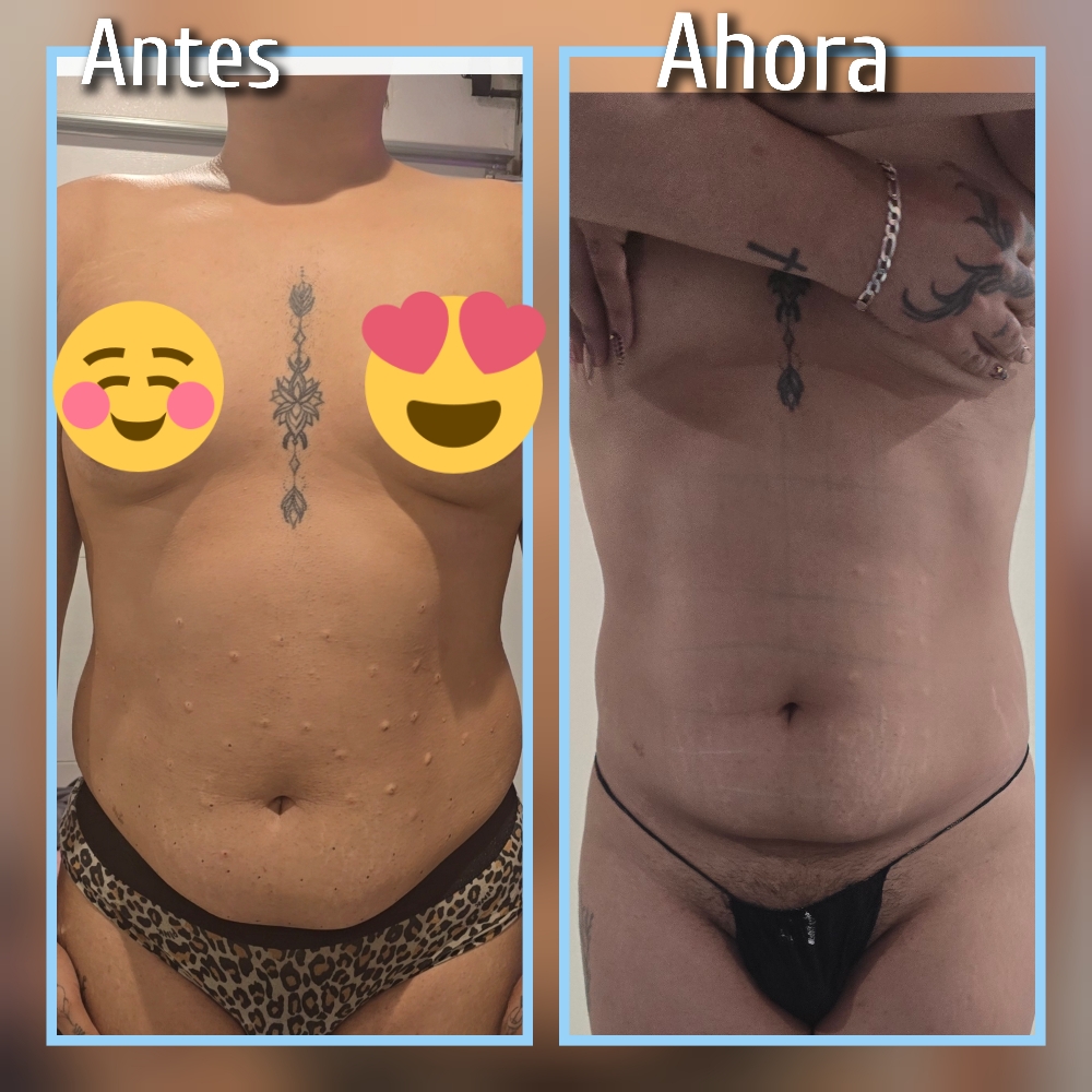 Tratamiento Reducción