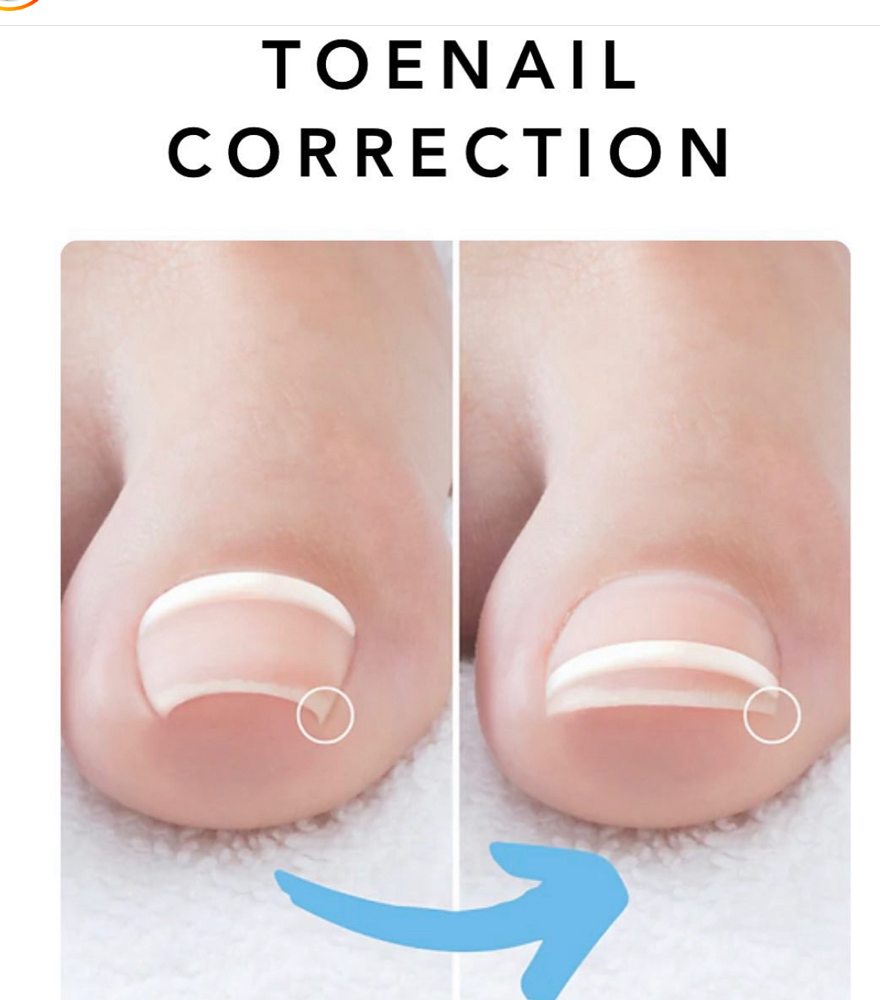 Ingrown Treatment Band (Per Toe)