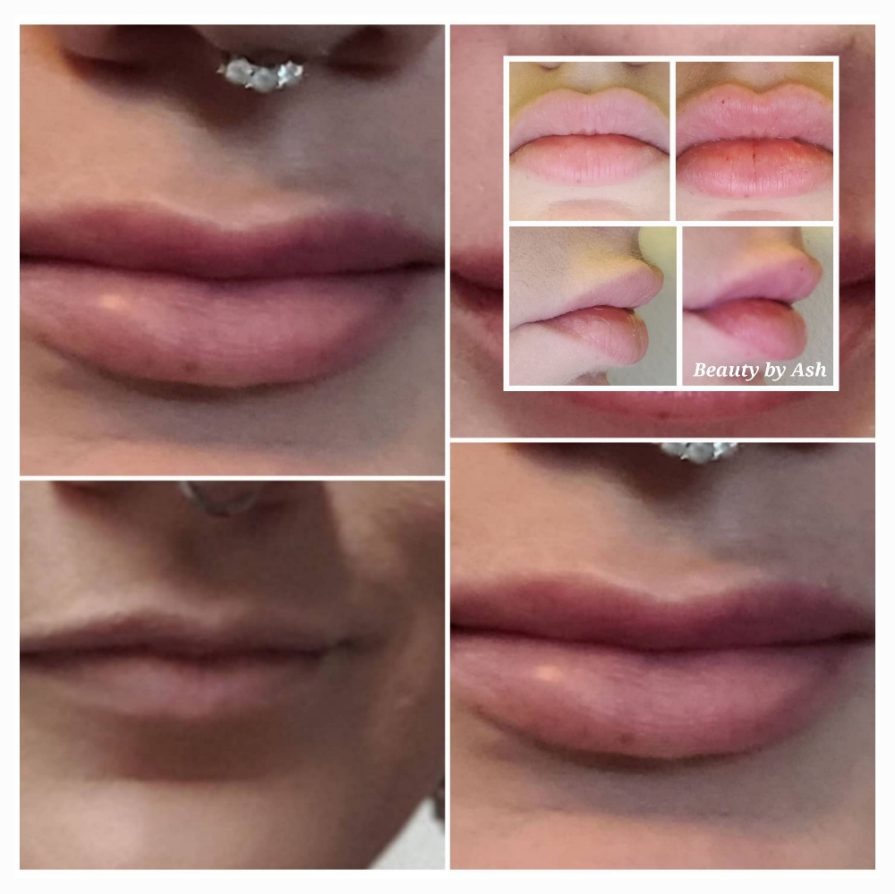 Hyaluronic Acid Filler