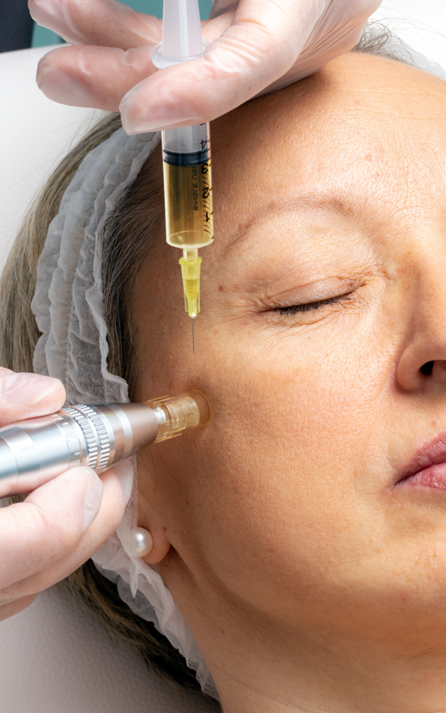 MicroNeedling