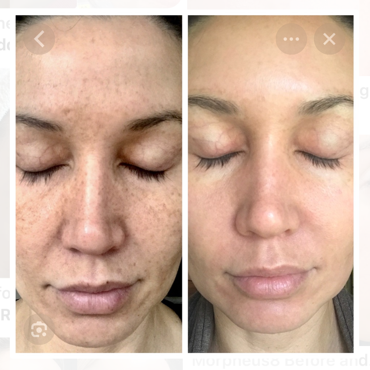 Resurfacing Facial at Esthetics With Michaela in Vidalia, LA