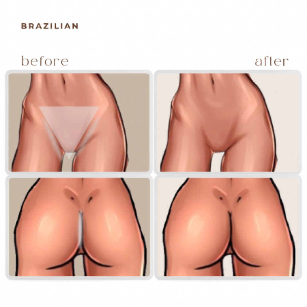 brazilian LASER HAIR REMOVAL at BEAUTY LAB COLLECTIVE in Miami, FL