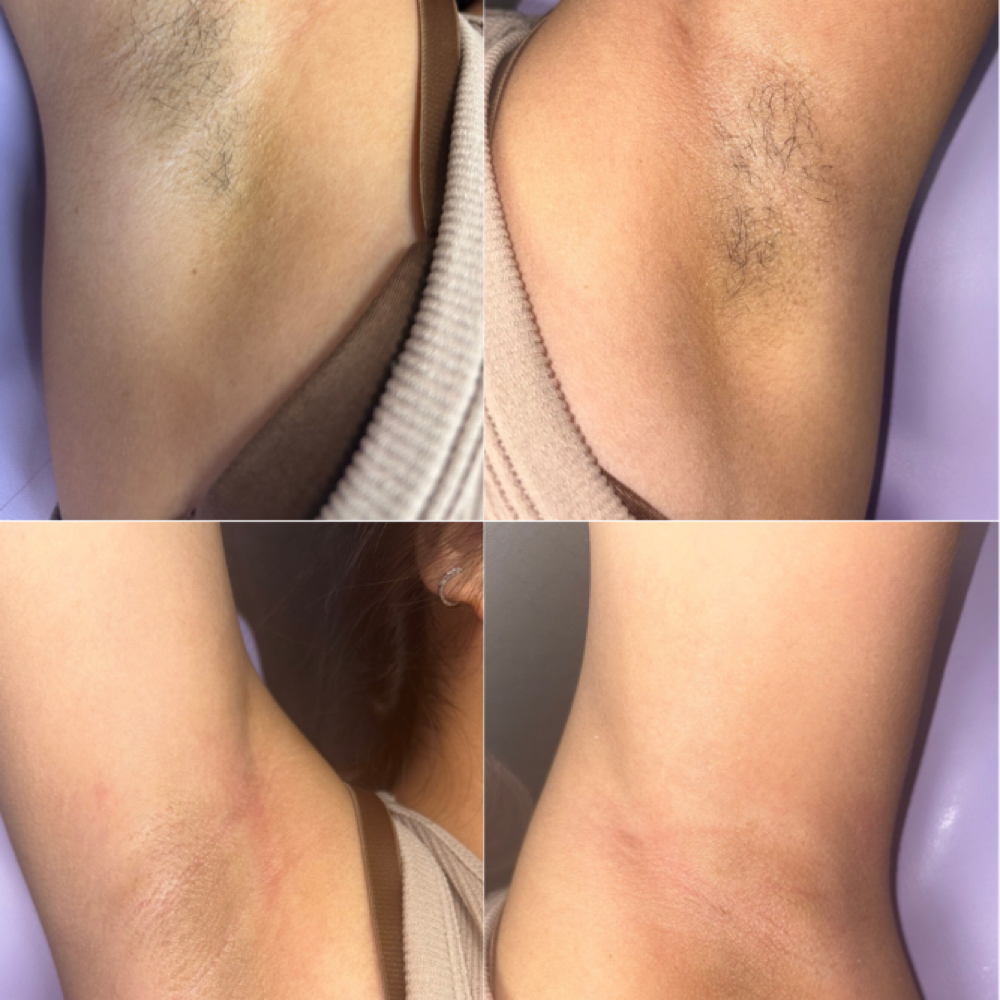 Underarm Wax at Kloudy Aesthetics in Fresno, CA