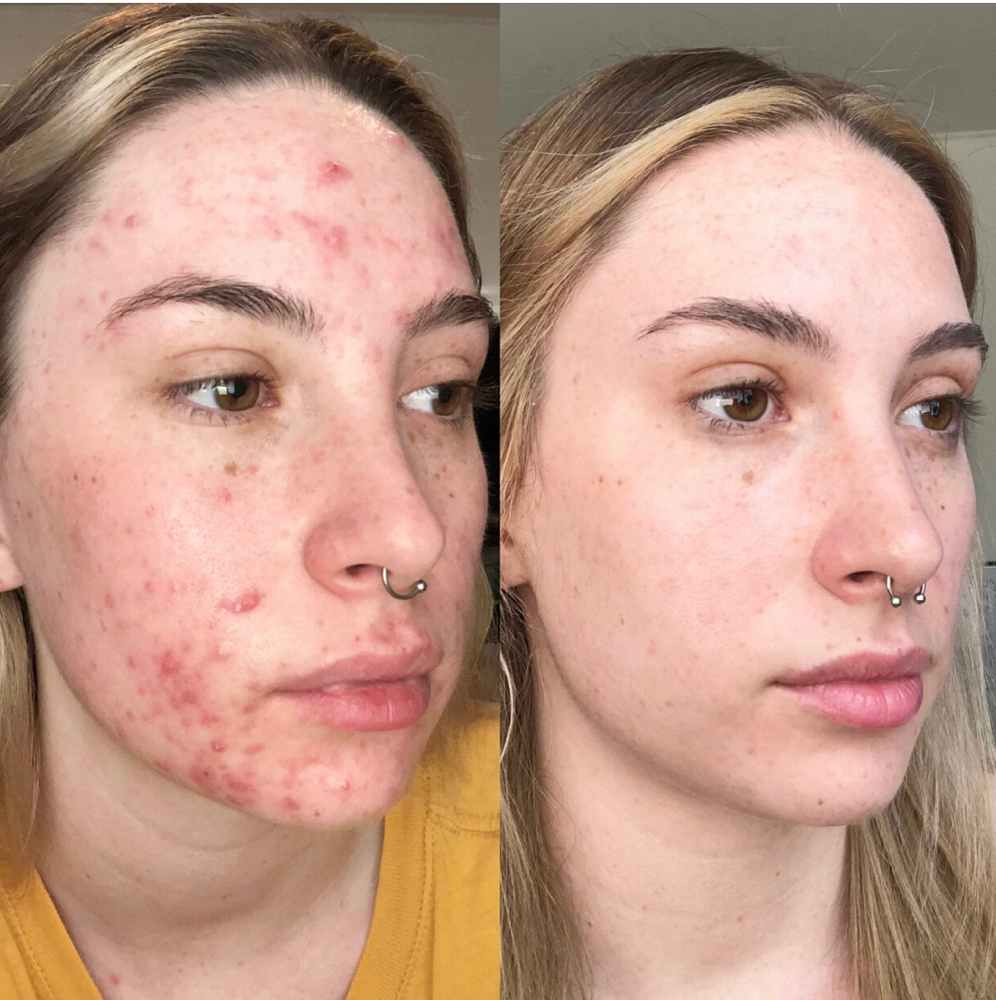 FaceReality Consult + 1st Treatment