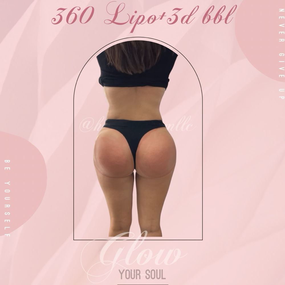 Body Sculpt 360+ BBL