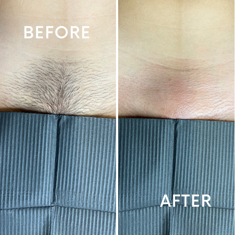 Brazilian Wax