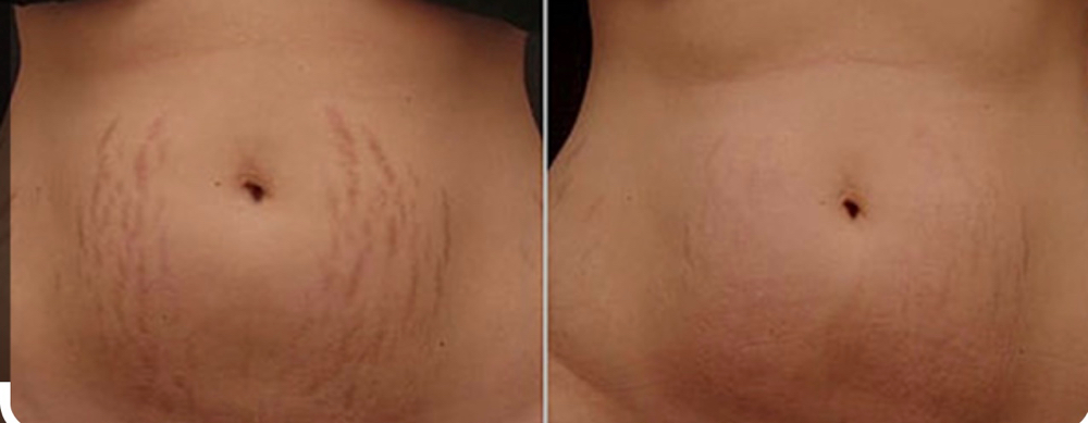 Ink-less Stretch Marks Revision