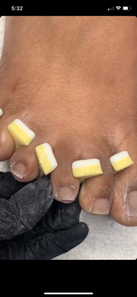 Toe Reconstruction All Toes